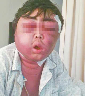 男子遭蚊子叮脸肿成球 嘴唇肿成香肠 系因被蚊